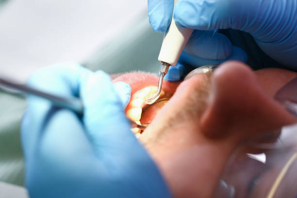 Best Emergency Wisdom Teeth Removal in Sylva, NC